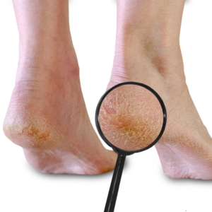 Pés ressecados e rachados? Veja o que seu corpo está tentando te dizer